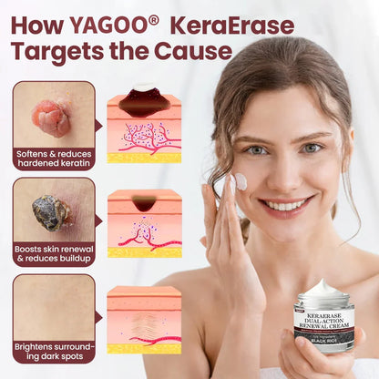 YAGOO® KeraErase Dual-Action Renewal Cream