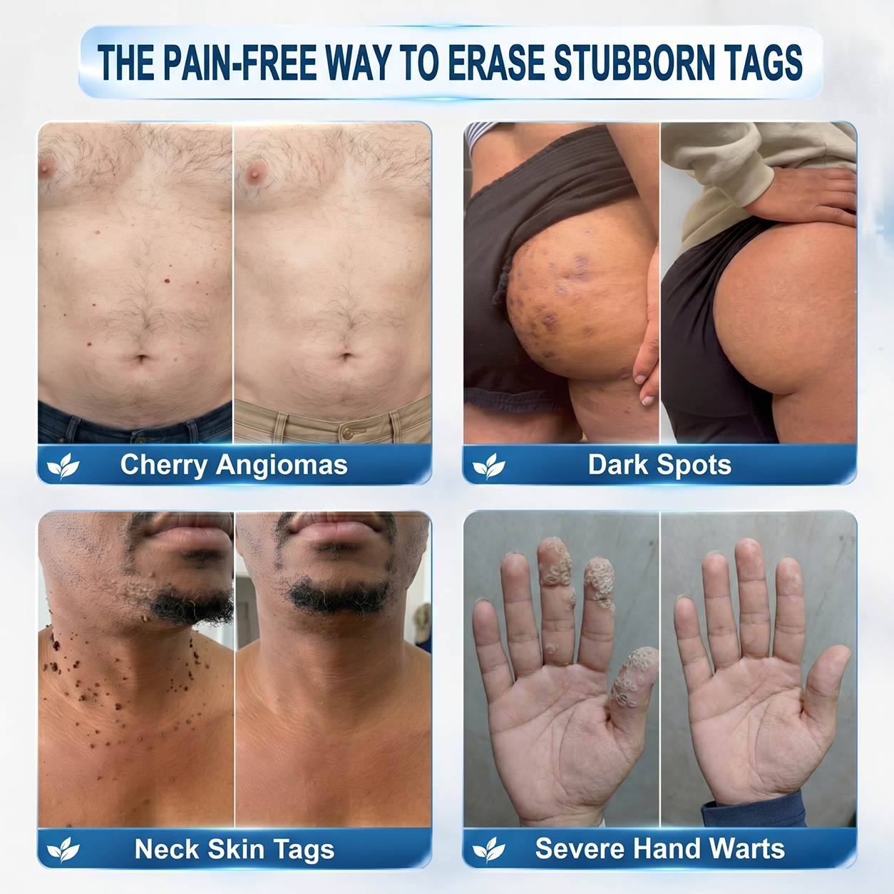FDA Registered Facility|𝟕-𝐃𝒂𝘆 𝐒𝗸𝐢𝐧 𝐓𝒂𝗴 & 𝐒𝐩𝙤𝐭 𝐄𝐫𝒂𝐬𝙚𝐫 Painless & Scar-Free Advanced Imperfection Removal Rollerball Pen