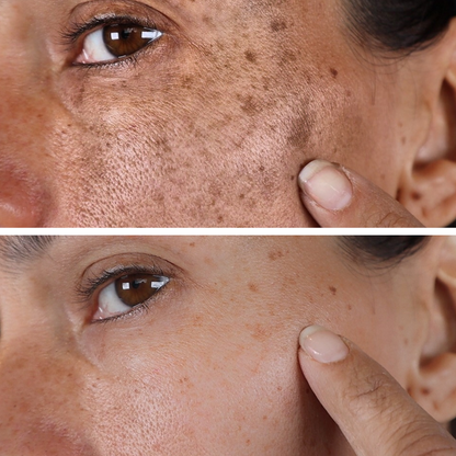 (🔥LAST DAY SALE-70% OFF)-Fast Dark Spot Remover-Tiworld™  Turmeric Spot Repair Serum