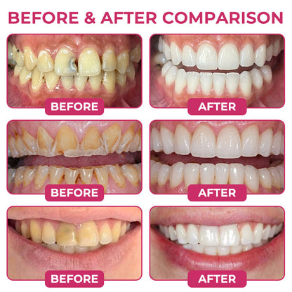 SEAGRIL® DenPerm Cavity-Repair Natural Enamel Filling Gel