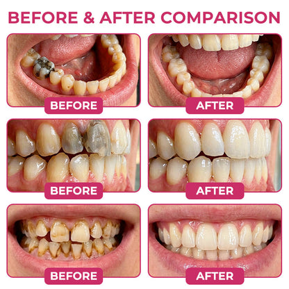 SEAGRIL® DenPerm Cavity-Repair Natural Enamel Filling Gel