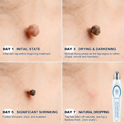 FDA Registered Facility|𝟕-𝐃𝒂𝘆 𝐒𝗸𝐢𝐧 𝐓𝒂𝗴 & 𝐒𝐩𝙤𝐭 𝐄𝐫𝒂𝐬𝙚𝐫 Painless & Scar-Free Advanced Imperfection Removal Rollerball Pen